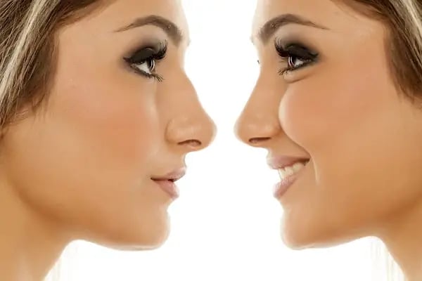 Op.Dr.Evren Ay Koç Rhinoplasty - Burun Estetiği - Resim 11