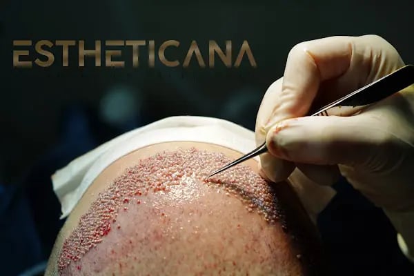 ESTHETICANA - Exclusive Hair Transplant in Turkey - Resim 7