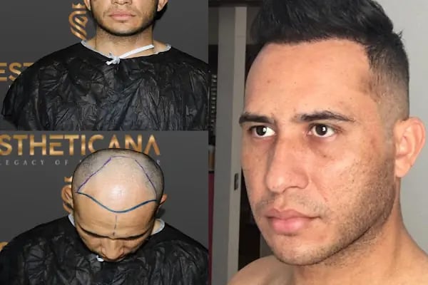 ESTHETICANA - Exclusive Hair Transplant in Turkey - Resim 13