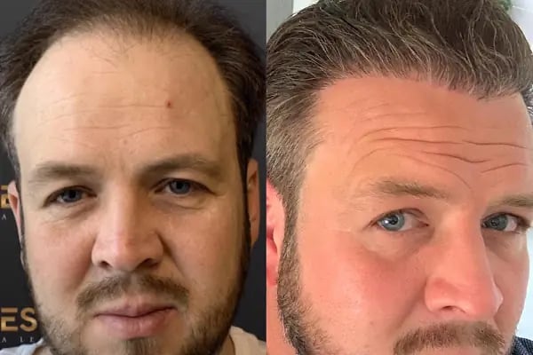ESTHETICANA - Exclusive Hair Transplant in Turkey - Resim 10