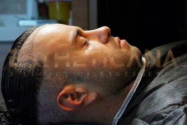 ESTHETICANA - Exclusive Hair Transplant in Turkey - Resim 8
