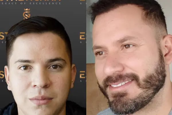 ESTHETICANA - Exclusive Hair Transplant in Turkey - Resim 11