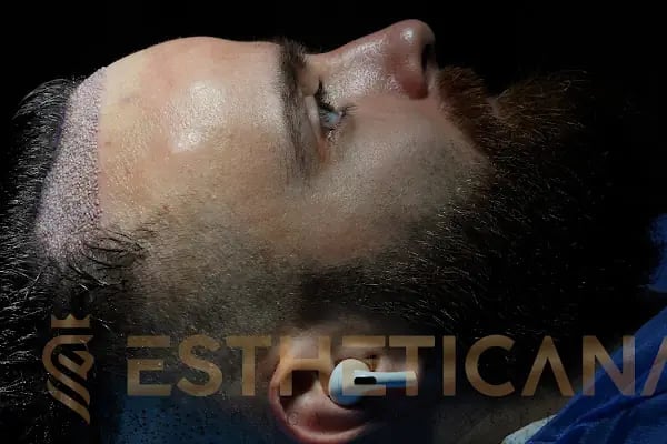 ESTHETICANA - Exclusive Hair Transplant in Turkey - Resim 14