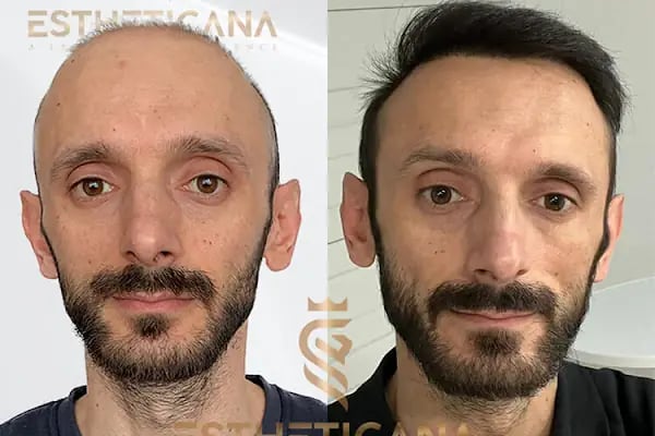 ESTHETICANA - Exclusive Hair Transplant in Turkey - Resim 6
