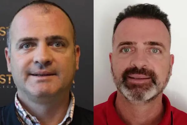 ESTHETICANA - Exclusive Hair Transplant in Turkey - Resim 9