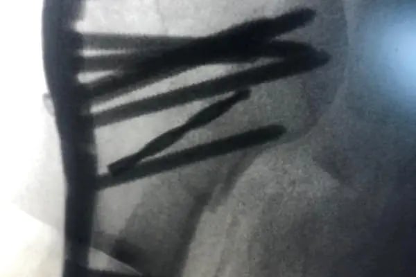 Prof. Dr. Mustafa Özkan , Ortopedi ve Travmatoloji , Üst Ekstremite ve El Mikrocerrahisi - Resim 11
