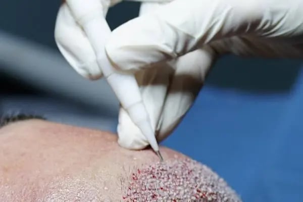 Unique Hair Transplant - Resim 14