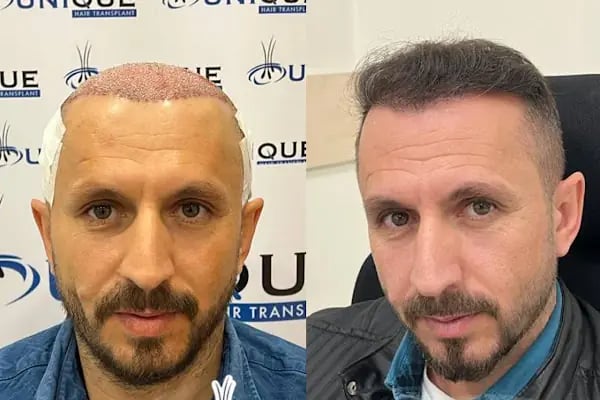 Unique Hair Transplant - Resim 13