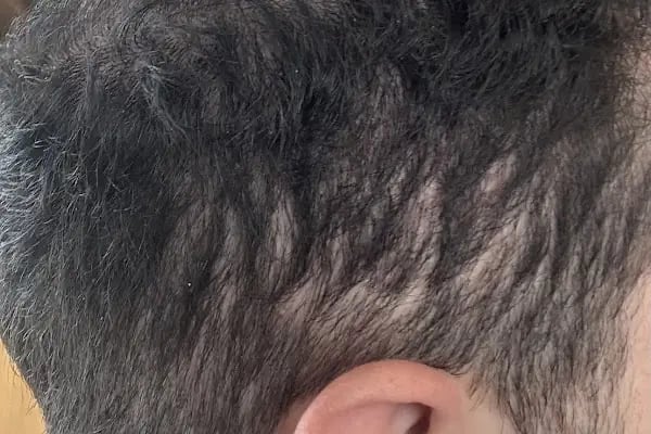Unique Hair Transplant - Resim 3