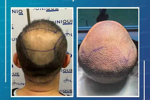 Unique Hair Transplant - Resim 19