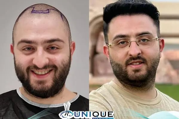 Unique Hair Transplant - Resim 7
