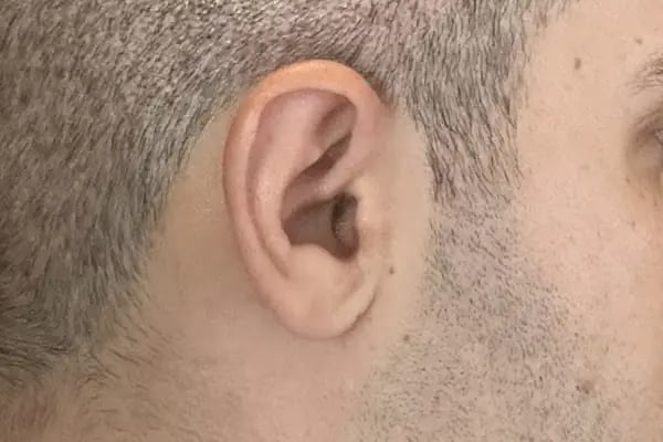 Unique Hair Transplant - Resim 5