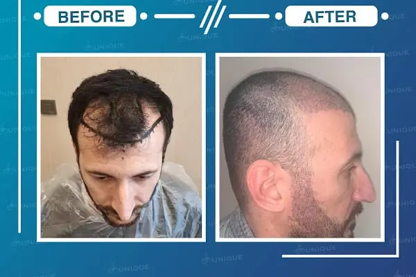 Unique Hair Transplant - Resim 20