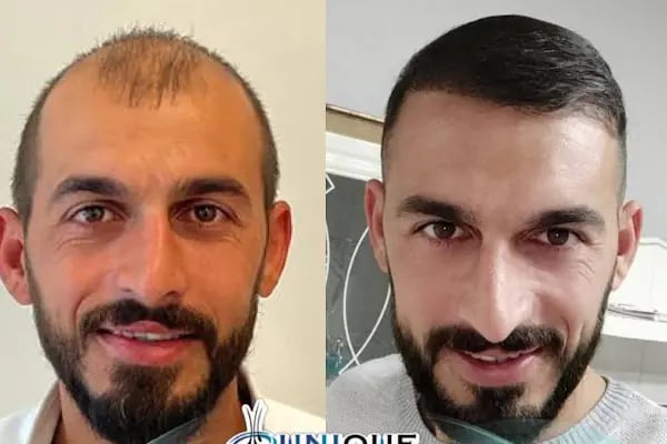 Unique Hair Transplant - Resim 16