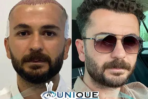 Unique Hair Transplant - Resim 2