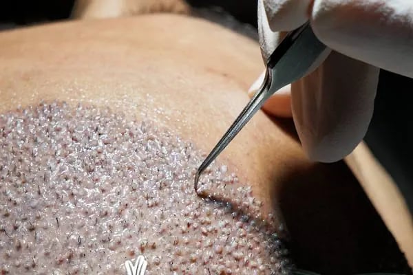 Unique Hair Transplant - Resim 10