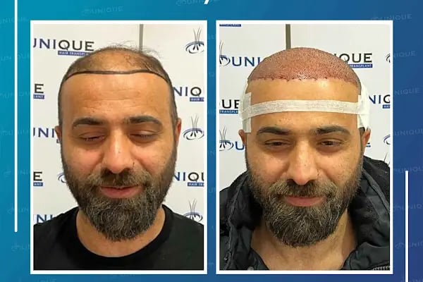 Unique Hair Transplant - Resim 12