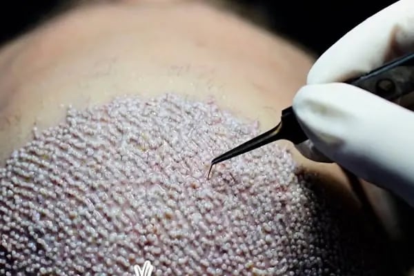 Unique Hair Transplant - Resim 15