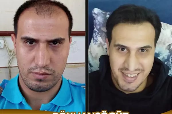 Gökhan Hair Clinic - Malatya Saç Ekim Merkezi - Resim 12
