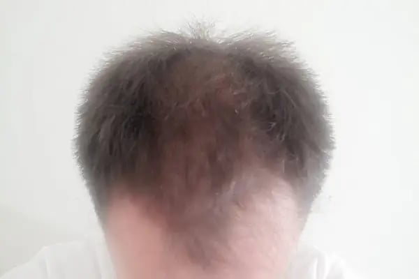 Gökhan Hair Clinic - Malatya Saç Ekim Merkezi - Resim 9