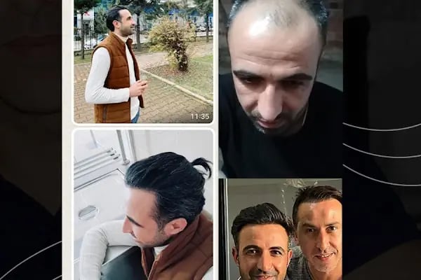 Gökhan Hair Clinic - Malatya Saç Ekim Merkezi - Resim 11