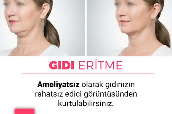 Uzman Doktor Kadriye Akar Konya Dermatolog (Botoks - Dolgu - Leke, Hacamat, Ozon Tedavisi, Sülük ve Akne Tedavisi) - Resim 7