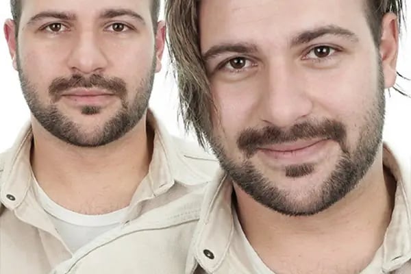 SWell Hair Protez Saç ve Gerçek Saç Peruk Merkezi Şişli - Hair Replacement - Medical Wigs - Resim 17