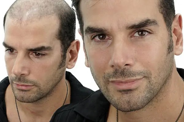 SWell Hair Protez Saç ve Gerçek Saç Peruk Merkezi Şişli - Hair Replacement - Medical Wigs - Resim 20