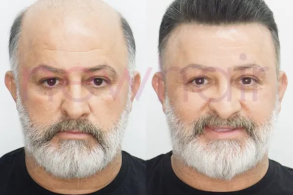 Newhair İzmir, Protez saç, Saç Protezi, Saç Ekimi, Kemoterapi, Hair Replacement, Toupee - Resim 7