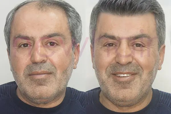 Newhair İzmir, Protez saç, Saç Protezi, Saç Ekimi, Kemoterapi, Hair Replacement, Toupee - Resim 8