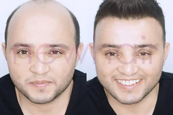 Newhair İzmir, Protez saç, Saç Protezi, Saç Ekimi, Kemoterapi, Hair Replacement, Toupee - Resim 9