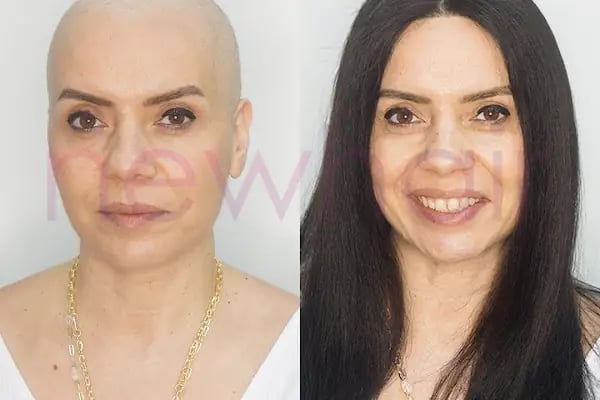 Newhair İzmir, Protez saç, Saç Protezi, Saç Ekimi, Kemoterapi, Hair Replacement, Toupee - Resim 11
