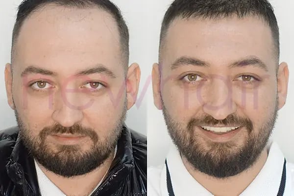 Newhair İzmir, Protez saç, Saç Protezi, Saç Ekimi, Kemoterapi, Hair Replacement, Toupee - Resim 1
