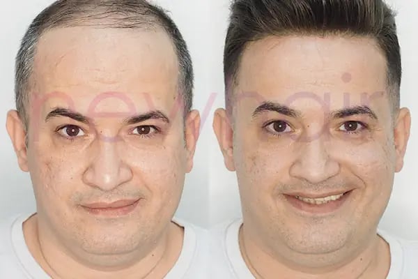 Newhair İzmir, Protez saç, Saç Protezi, Saç Ekimi, Kemoterapi, Hair Replacement, Toupee - Resim 13