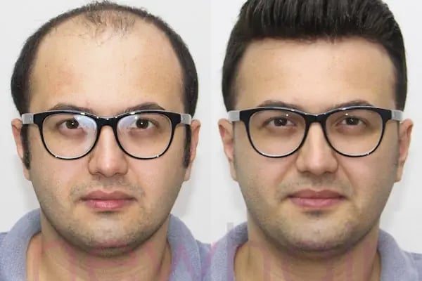Newhair İzmir, Protez saç, Saç Protezi, Saç Ekimi, Kemoterapi, Hair Replacement, Toupee - Resim 14