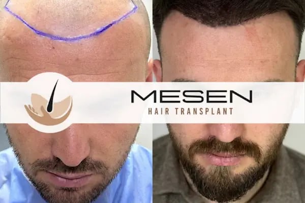 Mesen Saç Ekimi - Resim 19
