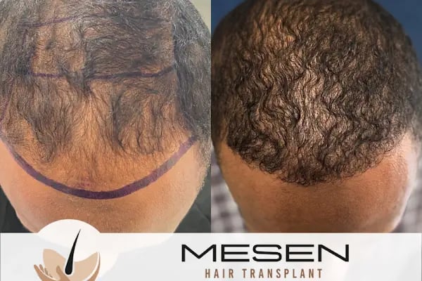 Mesen Saç Ekimi - Resim 20