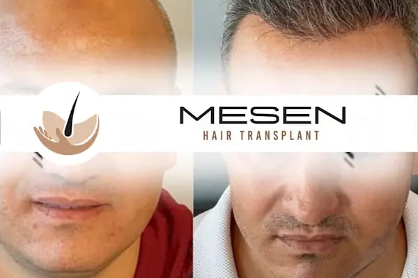 Mesen Saç Ekimi - Resim 18