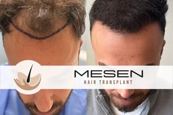 Mesen Saç Ekimi - Resim 6