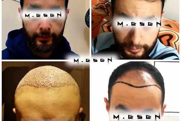 Mesen Saç Ekimi - Resim 17