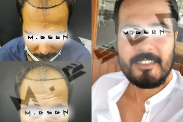 Mesen Saç Ekimi - Resim 12
