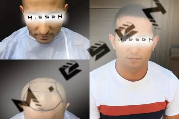 Mesen Saç Ekimi - Resim 14