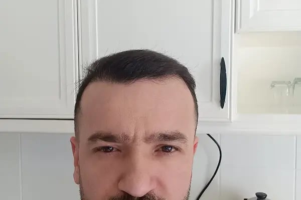 Mesen Saç Ekimi - Resim 5