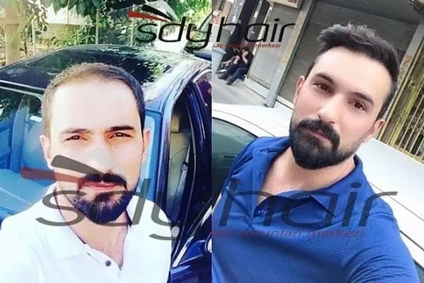 SDY Hair Saç Sorunları Merkezi - Resim 8