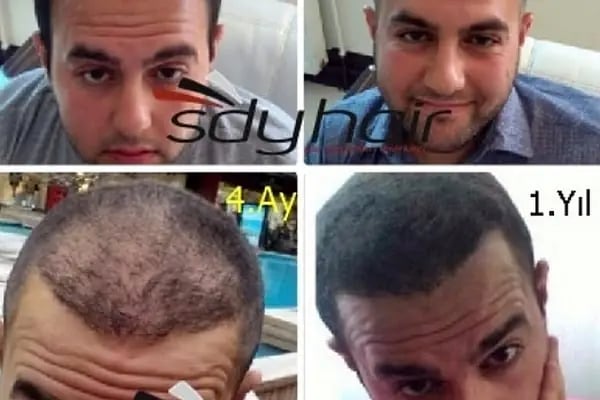SDY Hair Saç Sorunları Merkezi - Resim 5