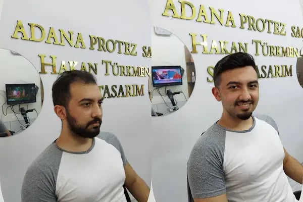 Adana Protez Saç Merkezi - Resim 6