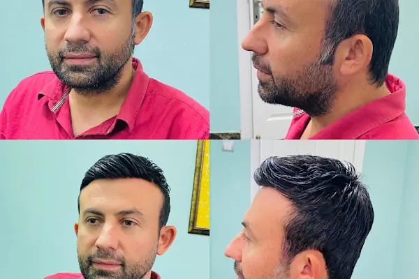 serkan cengiz protez saç merkezi adana - Resim 8