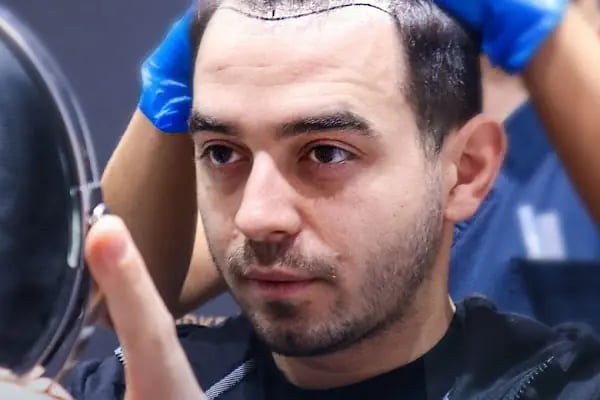 Hairpol | Hair Transplant Clinic (Saç Ekimi Kliniği) - Resim 12