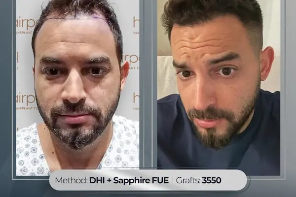 Hairpol | Hair Transplant Clinic (Saç Ekimi Kliniği) - Resim 6