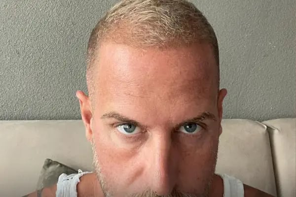 Hairpol | Hair Transplant Clinic (Saç Ekimi Kliniği) - Resim 20